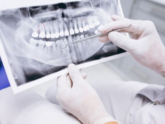 Rodzaje zdjęć rentgenowskich zębów